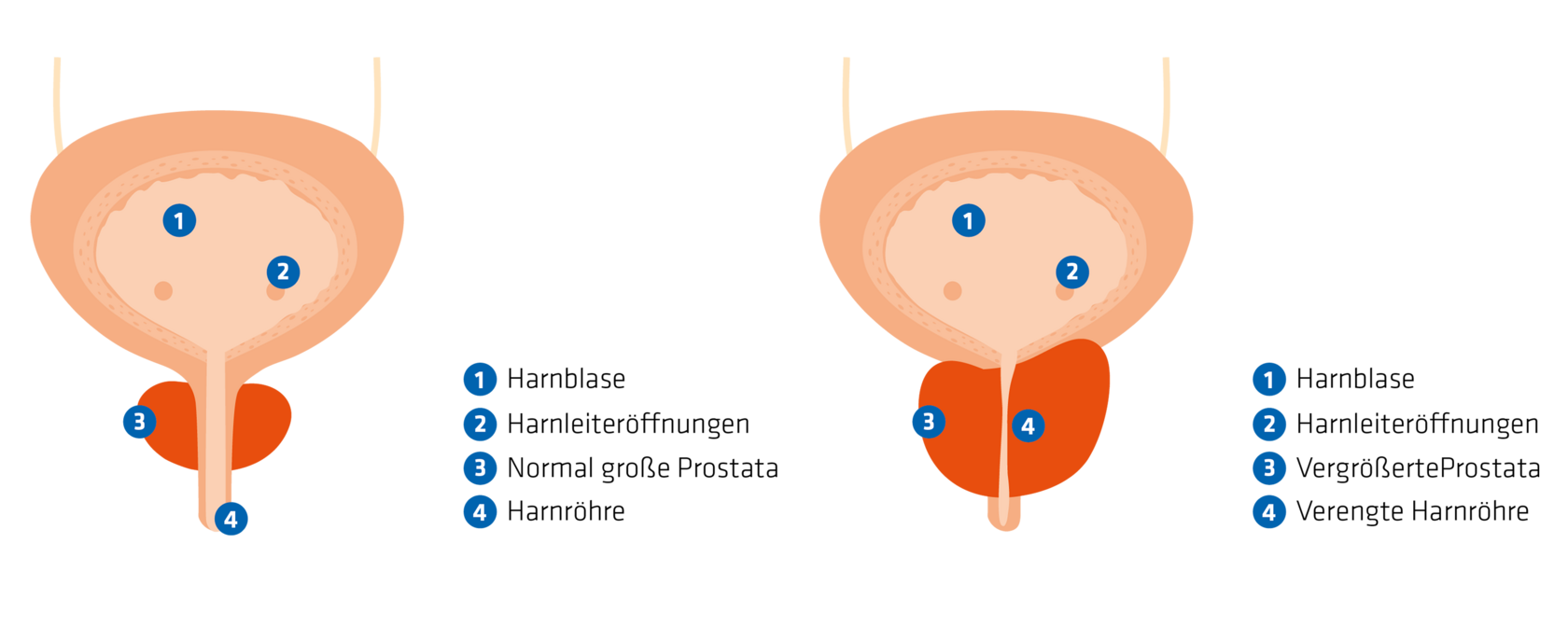 Grafik vergleicht eine Harnblase bei normaler und gutartigen Vergrößerung der Prostata.