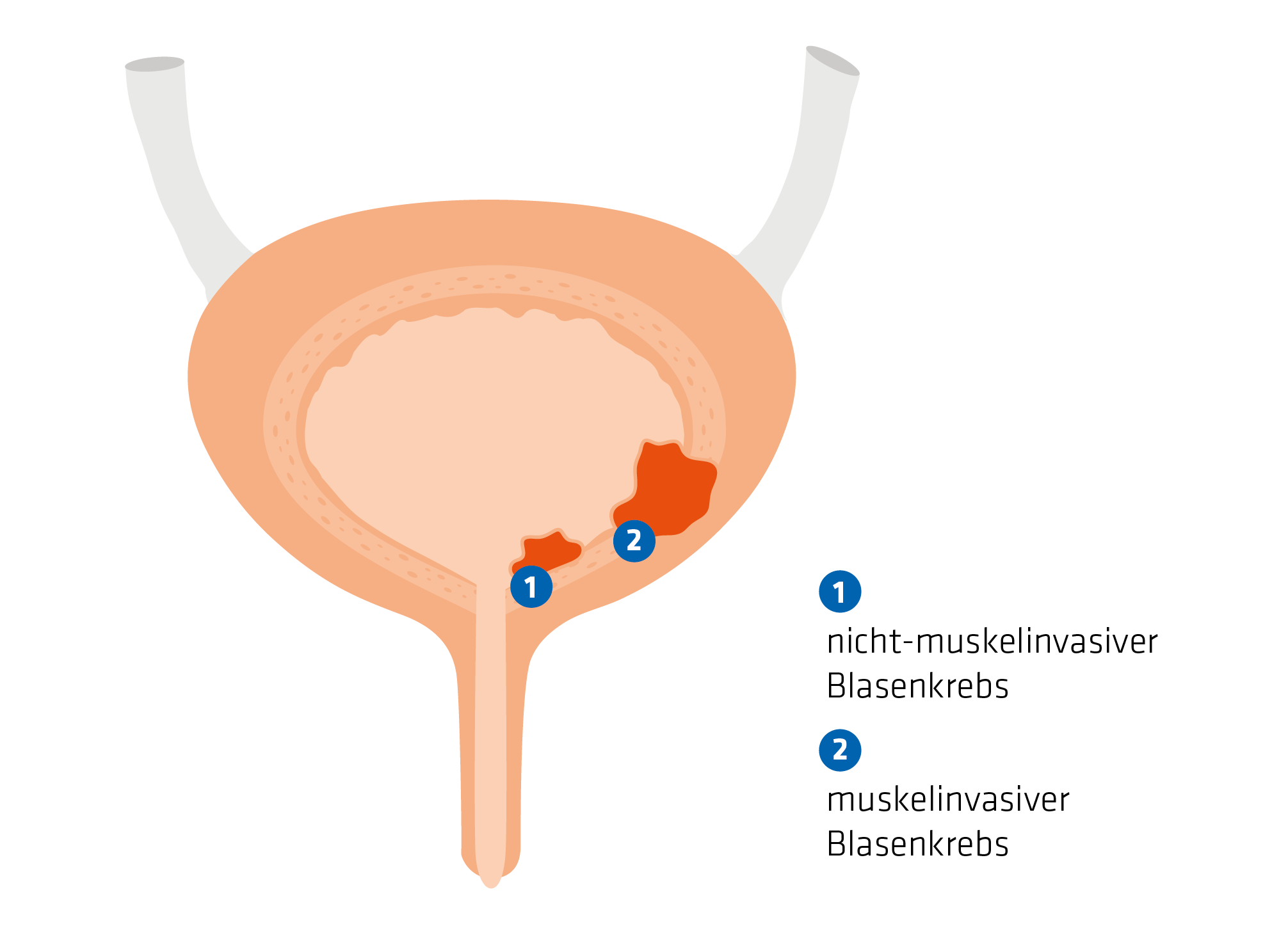 Infografik zeigt den Unterschied von nicht muskelinvasivem und nicht-muskelinvasivem Blasenkrebs.